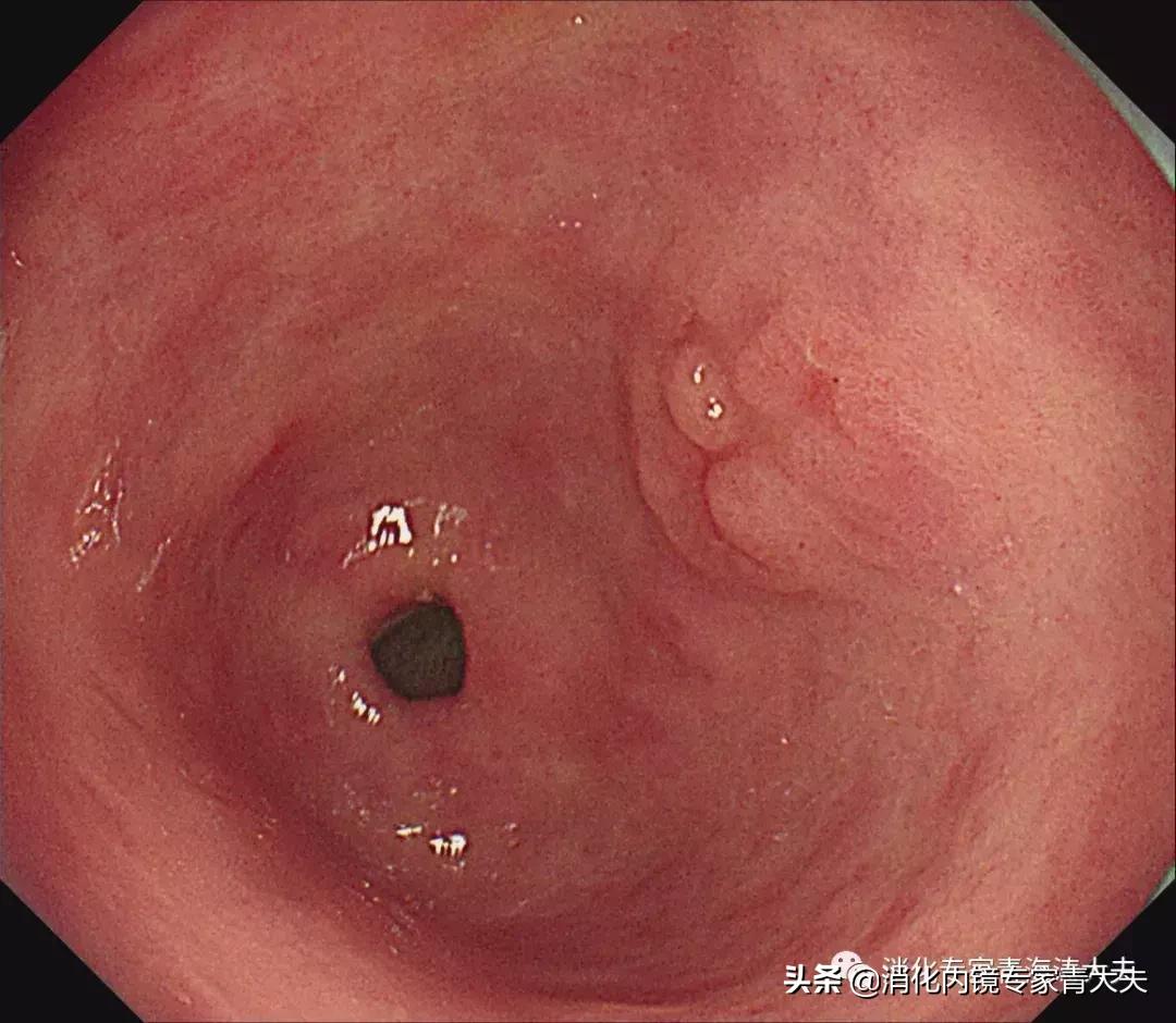 关于胃原位癌的科普文章,消化道早癌科普文章