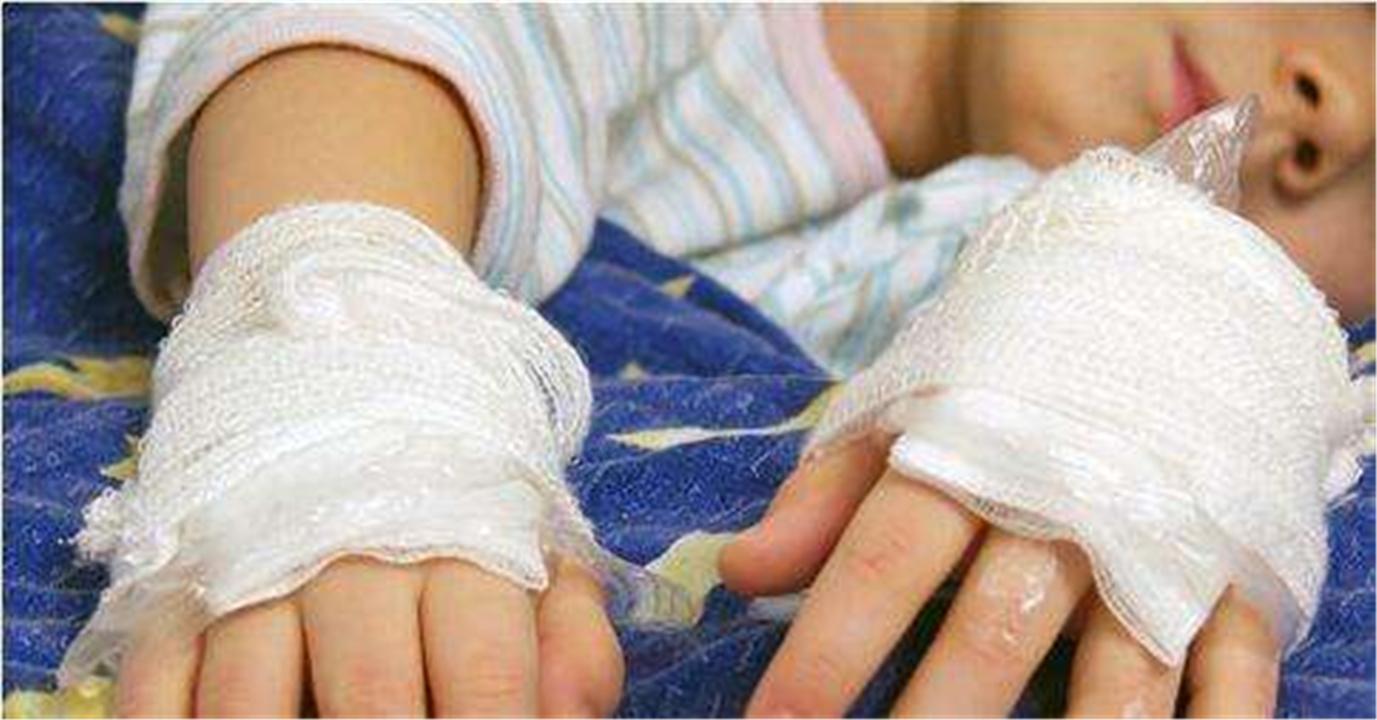 儿童不小心被烫伤用什么药膏,孩子被烫伤的黄金怎么处理