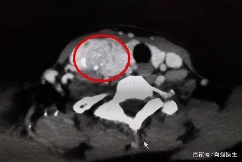 良性甲状腺结节不必手术名医讲堂,甲状腺结节名医