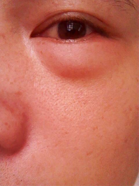 长期脚脖肿怎么回事,脚脖子肿疼用什么能好得快