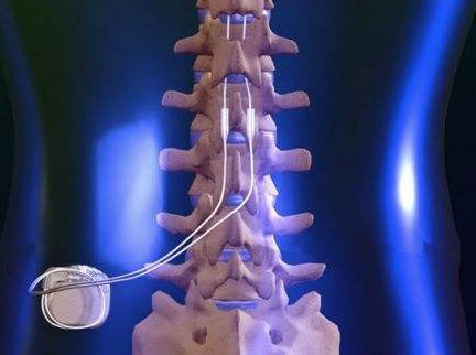 神经元修复治疗癫痫最近进展,癫痫治疗新方法神经调控治疗