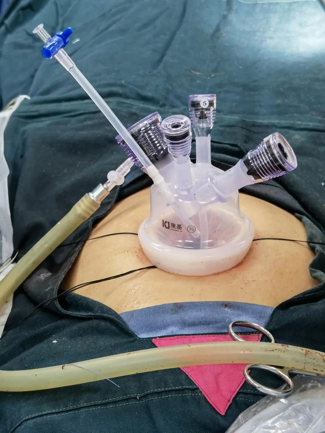 14岁女孩发胖肚子变大,24岁女孩发胖误以为怀孕