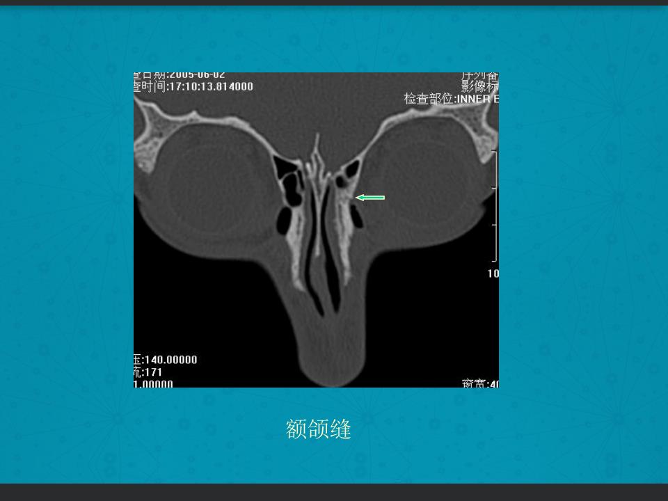 鼻骨骨折复位全过程,诊断证明鼻骨骨折问号是什么意思