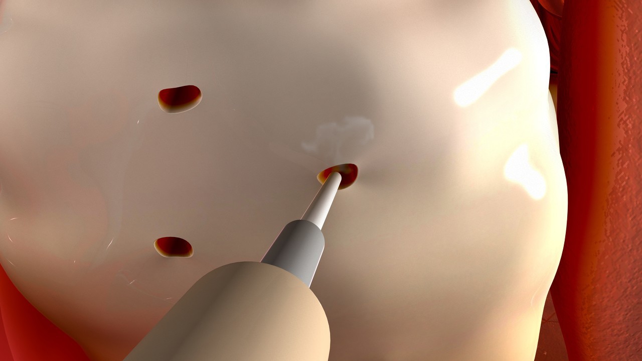 卵巢炎有什么明显症状,卵巢内分泌失调的症状怎么治疗