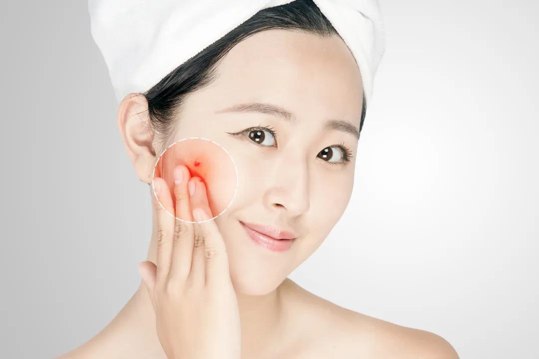 使用化妆品导致过敏怎么办,脸上化妆品过敏红肿怎么办