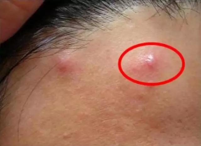 库博士专业祛痘脸部需要多少钱,库博士祛痘效果怎么样