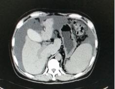 肝硬化及炎症手术的难度很大,肝硬化细胞治疗最新临床课题