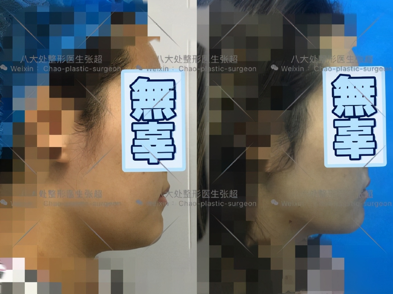 八大处整形张超,八大处张超最新视频