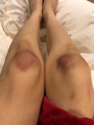 范玮琪摔倒陈建州,范玮琪摔伤的原因