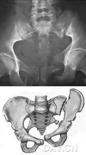 所有骨折都叫什么名字,骨折的名称有哪些