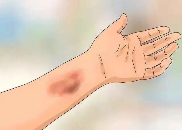 采血后鼓包有淤青有影响吗,抽血后淤青鼓包硬硬的疼痛