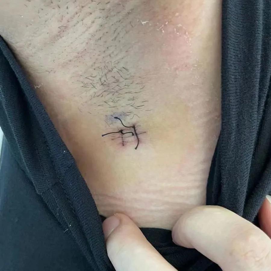 手汗症微创手术切口几天能恢复,手汗症手术切口怎么处理的