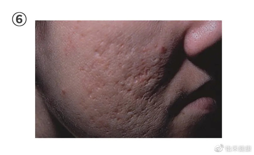 你以为的黑头真的是黑头吗,讨厌的黑头真的会变成草莓鼻吗