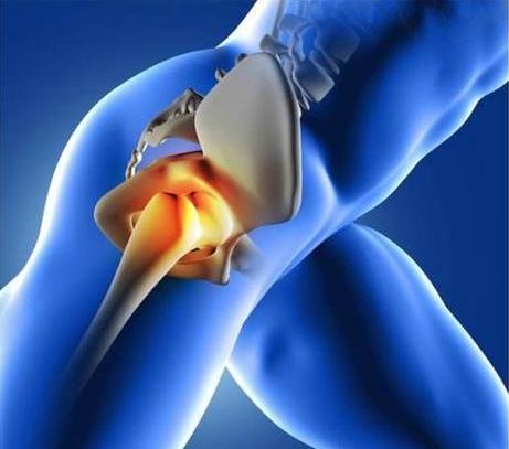 髋关节疼痛自愈的最佳方法,髋关节疼痛走路一瘸一拐