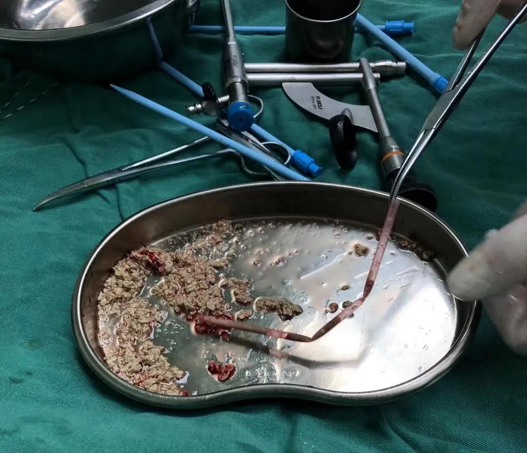 80岁大爷体内取出25厘米长管子,七旬老人体内取出65厘米超长血液