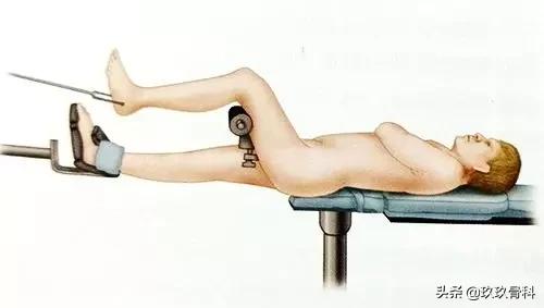 胫腓骨骨折髓内钉手术方式,髓内钉骨折最佳治疗方案