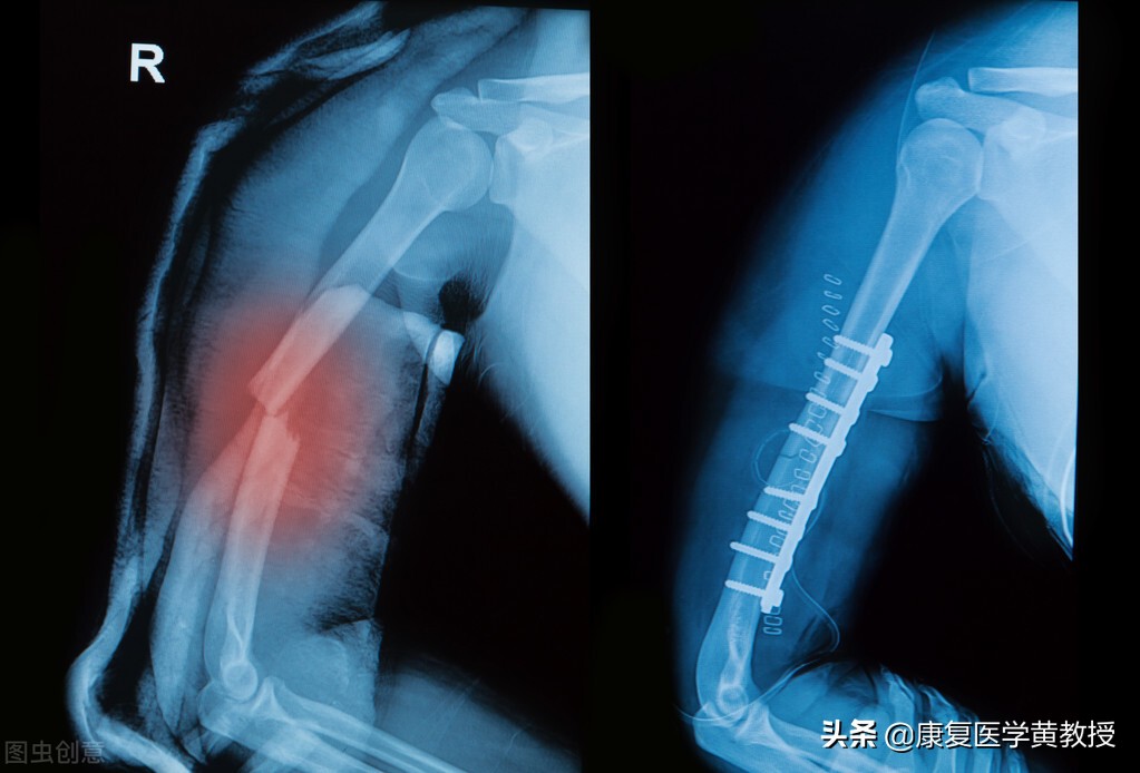 骨折肌肉萎缩最佳恢复方法,骨折后鸡肌萎缩是什么症状