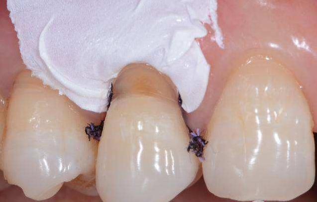 横着刷牙牙齿磨损能补吗,横向刷牙牙根磨损严重怎么修复