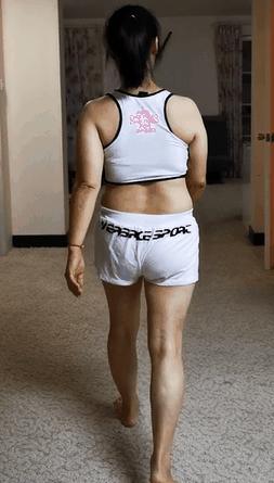 常见腿型矫正,长短腿矫正前矫正后对比