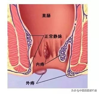 俗话说十人九痔得了痔疮很难受,十人九痔人人都有痔疮吗