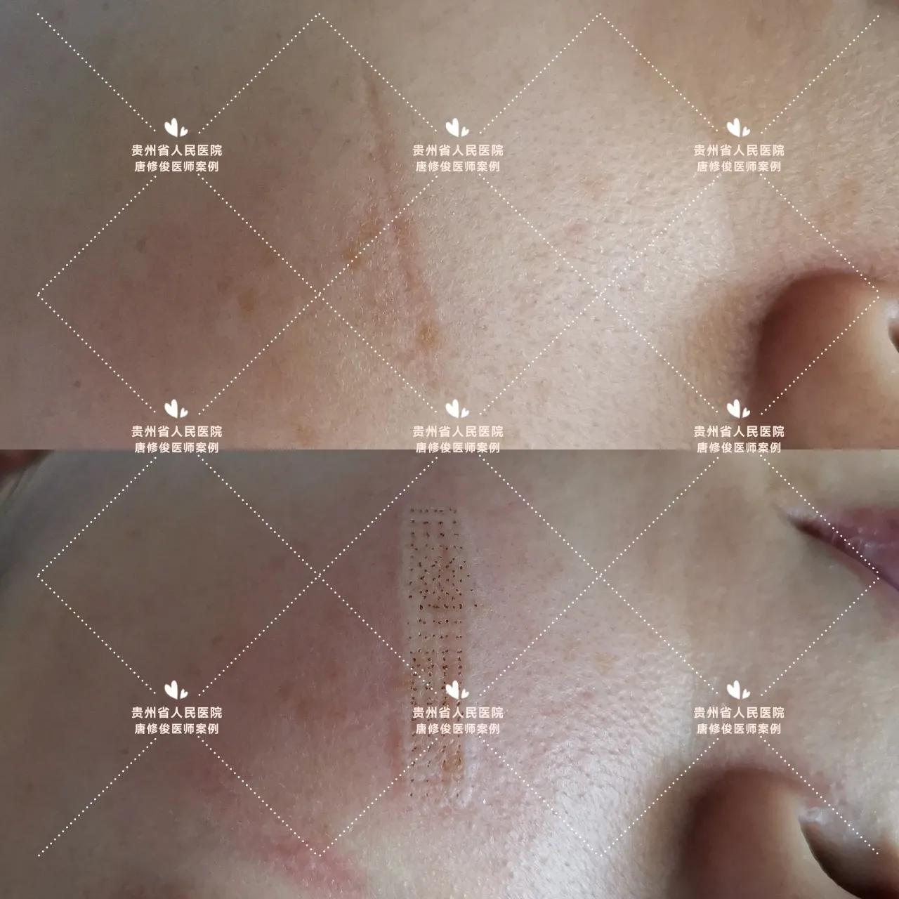 点阵激光祛疤痕增生会复发不,点阵激光治疗疤痕有效吗