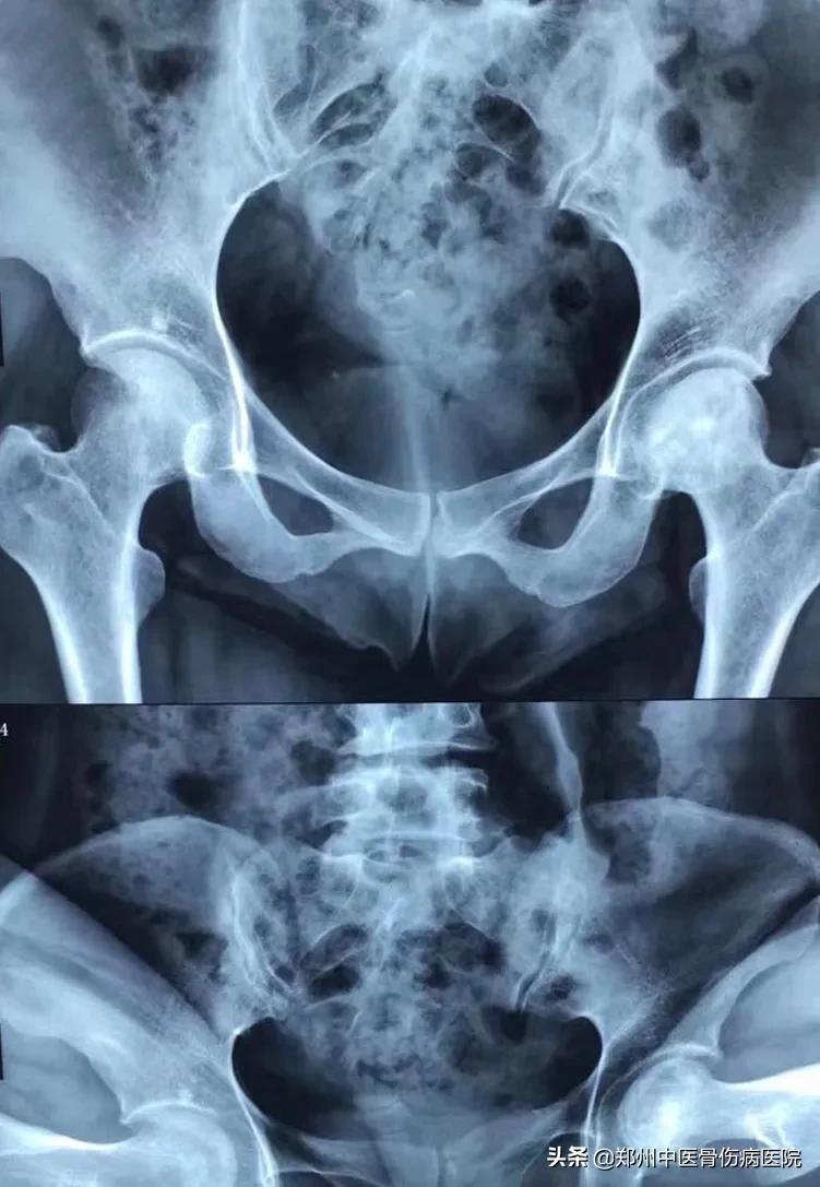 得了股骨头坏死应注意什么,得了股骨头坏死该怎么治疗