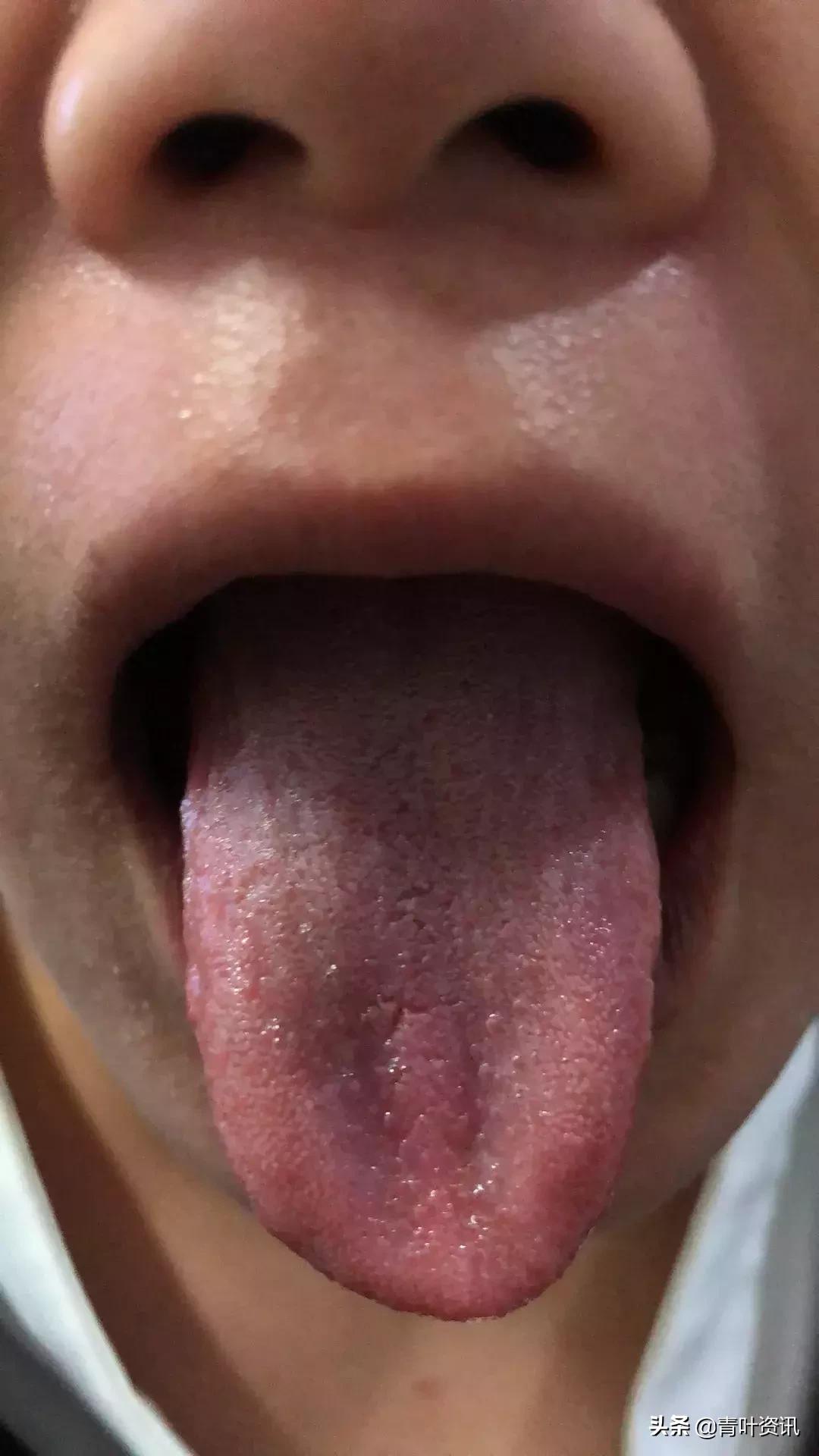 吃火锅过敏起红疹子,夏天吃火锅过敏