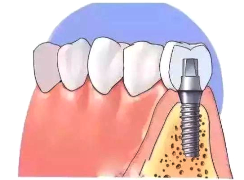 缺牙对寿命有影响吗,99%的人都不知道健康有多重要
