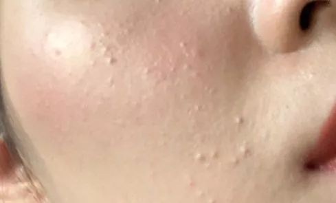 脸部黑头粉刺有必要去美容院挤吗,粉刺黑头应不应该挤掉