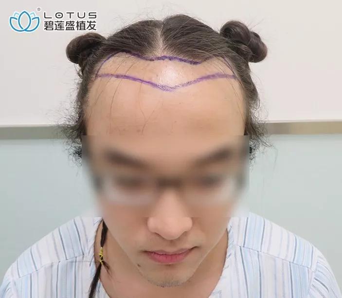 发际线后移额角大头发稀疏怎么办,额角发际线还能恢复吗