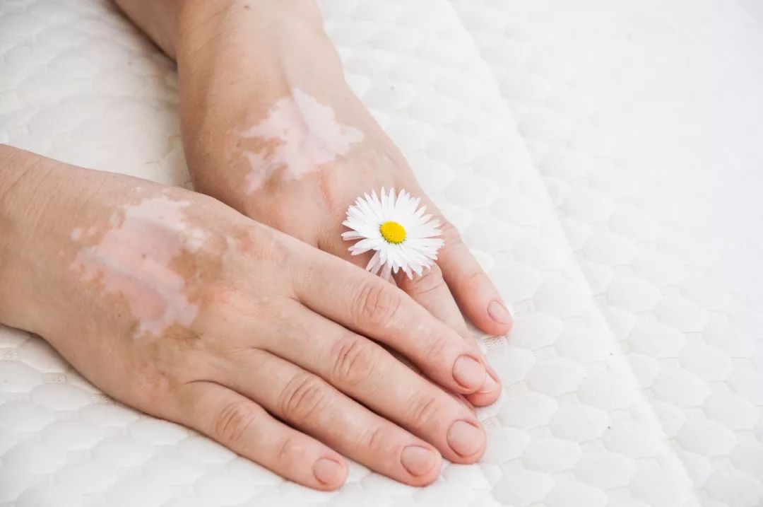 疤痕留下的白斑与外伤同形反应引起的白癜风有什么区别？