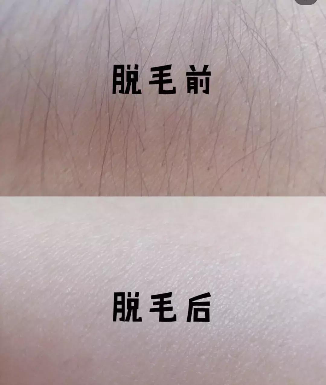 史上最实用脱毛术!夏天再也不为这事发愁啦