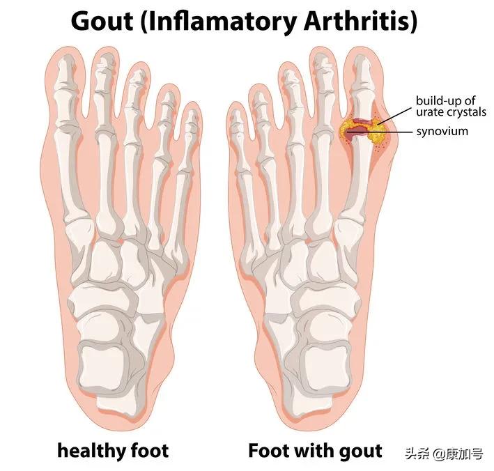 痛风治疗前沿,医学对痛风的最新研究
