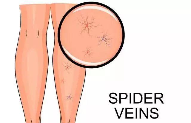 小孩腿静脉曲张,孩子腿上有静脉曲张