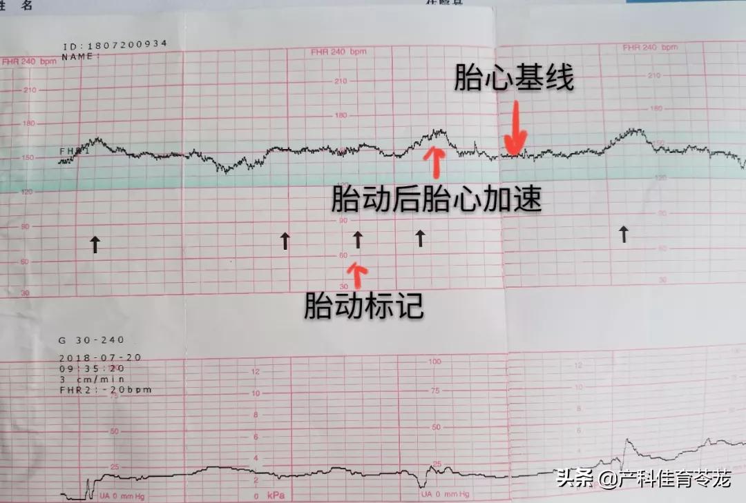胎心监护脐带受压怎么解决,做胎心监护能看出来脐带问题吗