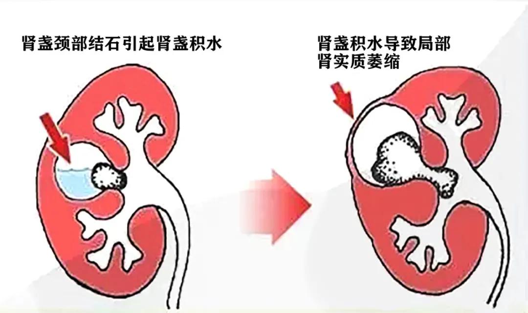 输尿管堵塞引起肾积水还能喝水吗,为什么喝水可以排出结石