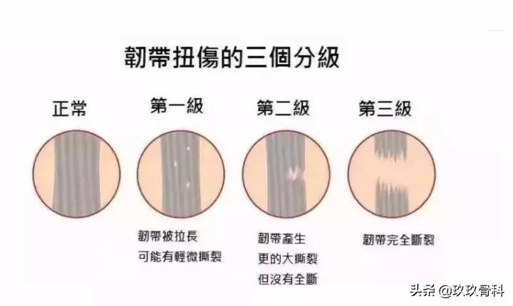 脚踝扭伤一个月后康复训练法,脚踝扭伤是否需要康复训练