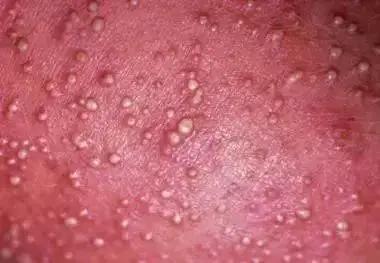 现在宝宝背上有痱子怎么办,宝宝脸上和脖子上全是疹子