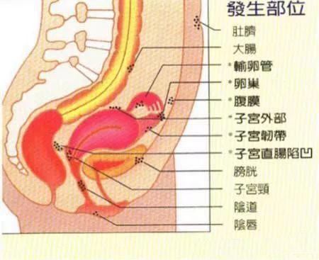 她用医生教的方法,查出体内有妇科肿瘤,救了自己一命