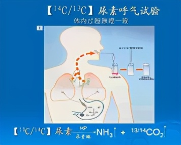 幽门螺杆菌治好后再次感染的几率,一人感染螺旋杆菌全家治疗