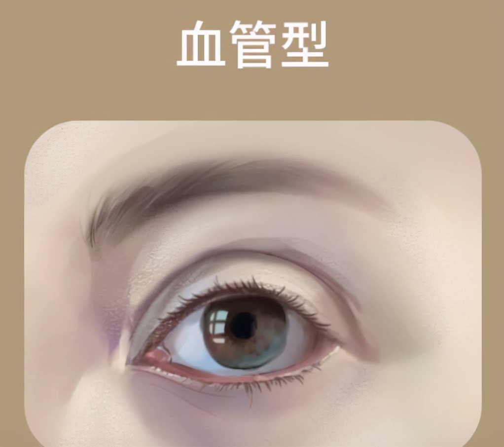 关于黑眼圈你知道多少,如何判断你是哪种黑眼圈