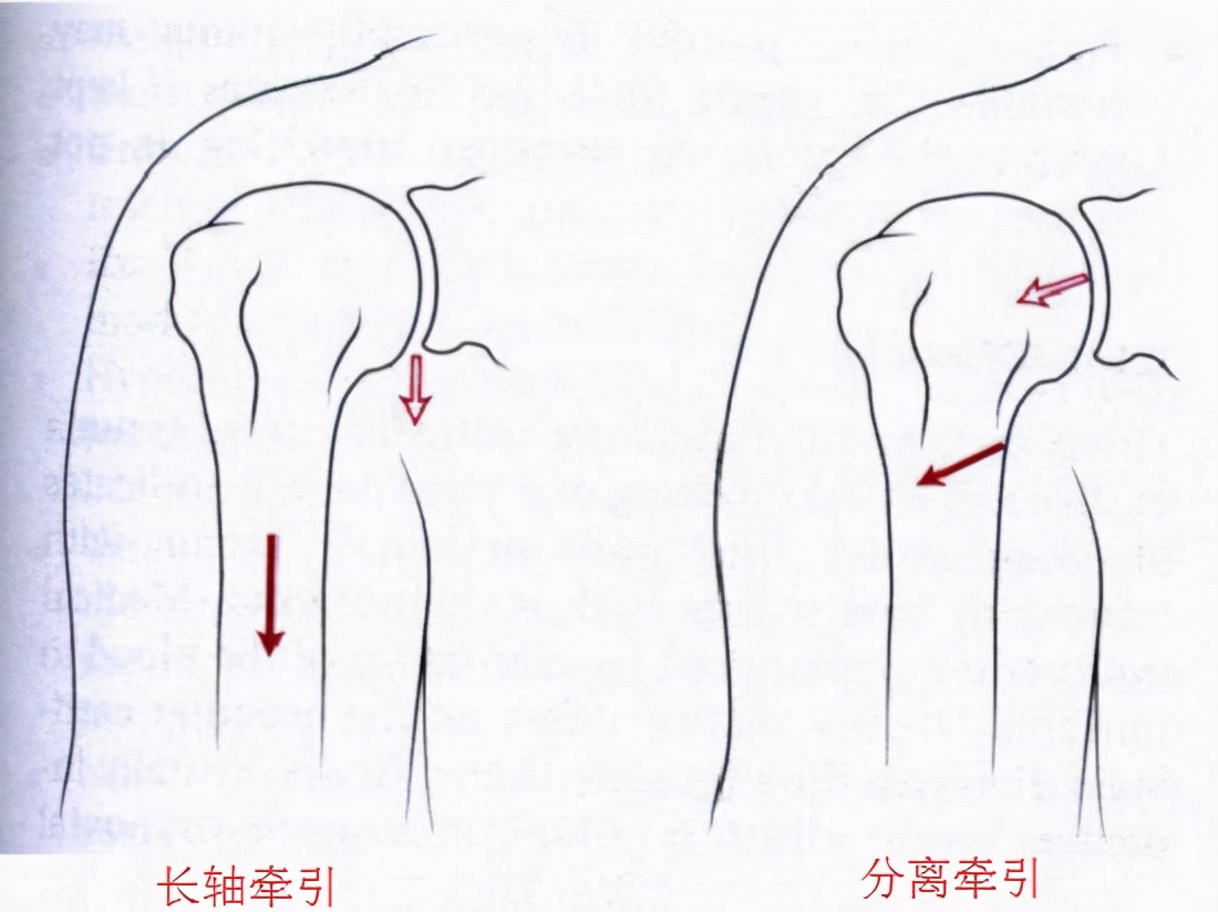 大关节松动训练,什么是关节松动