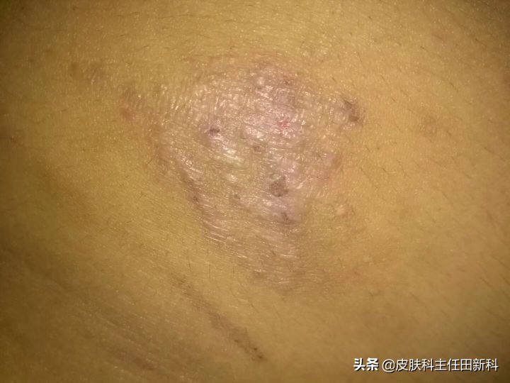 真菌感染性皮肤病原因,人真菌皮肤病怎么治