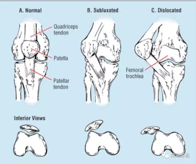 膝关节的22种常见病治疗,膝关节疼痛的相关知识