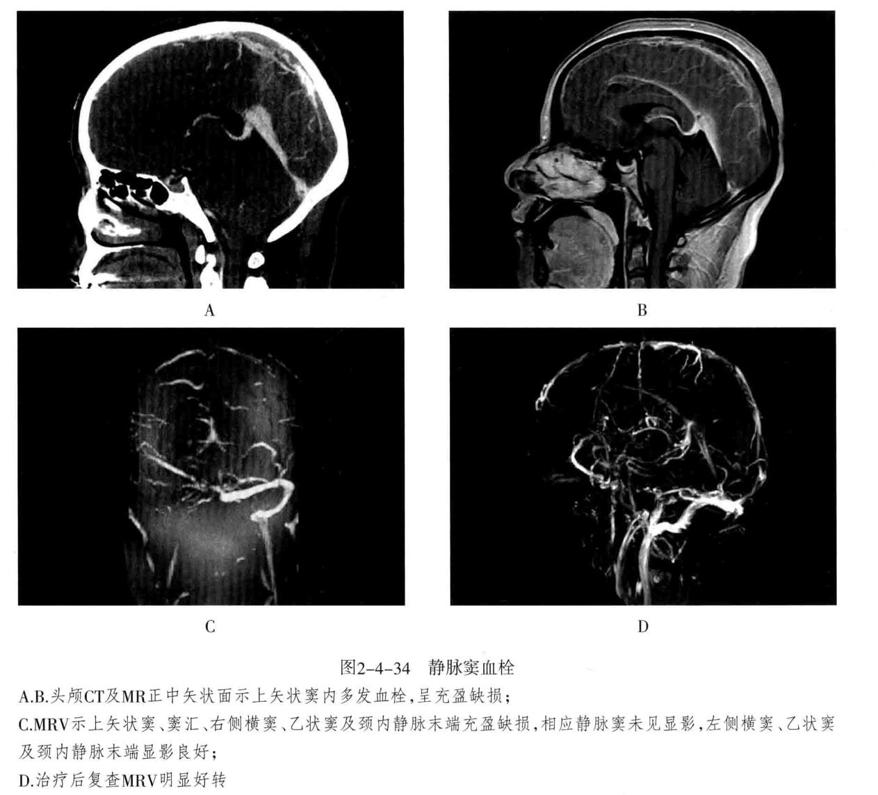 颅内血管轻度狭窄诊断标准,颅内血管先天变异影像