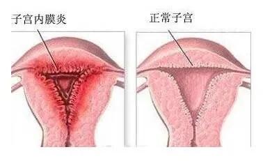 子宫内膜增生做活检能检测出癌吗,子宫内膜增生能怀孕吗