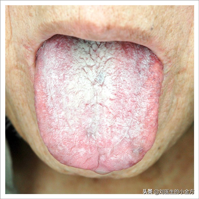 中医舌诊图解100例,中医舌诊图与舌诊口诀