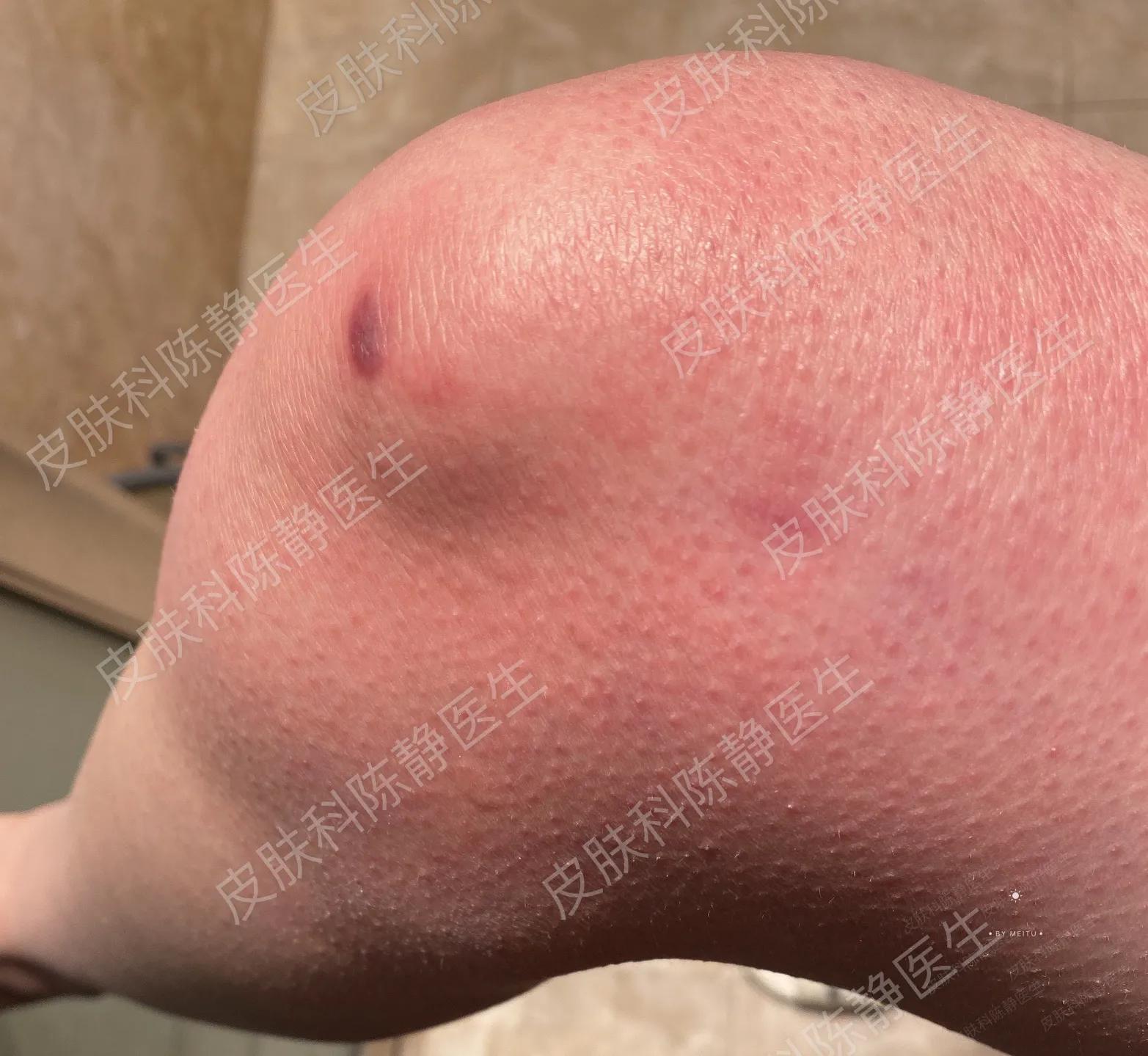 消毒液致皮肤病,皮肤病消毒