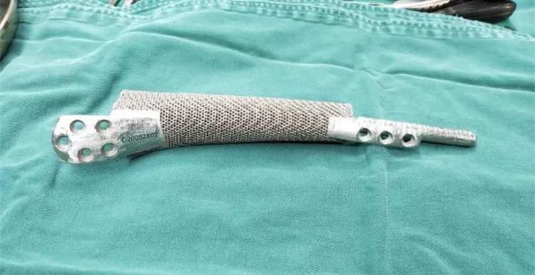 颅底骨折3d打印,3d打印技术辅助治疗胫骨平台骨折