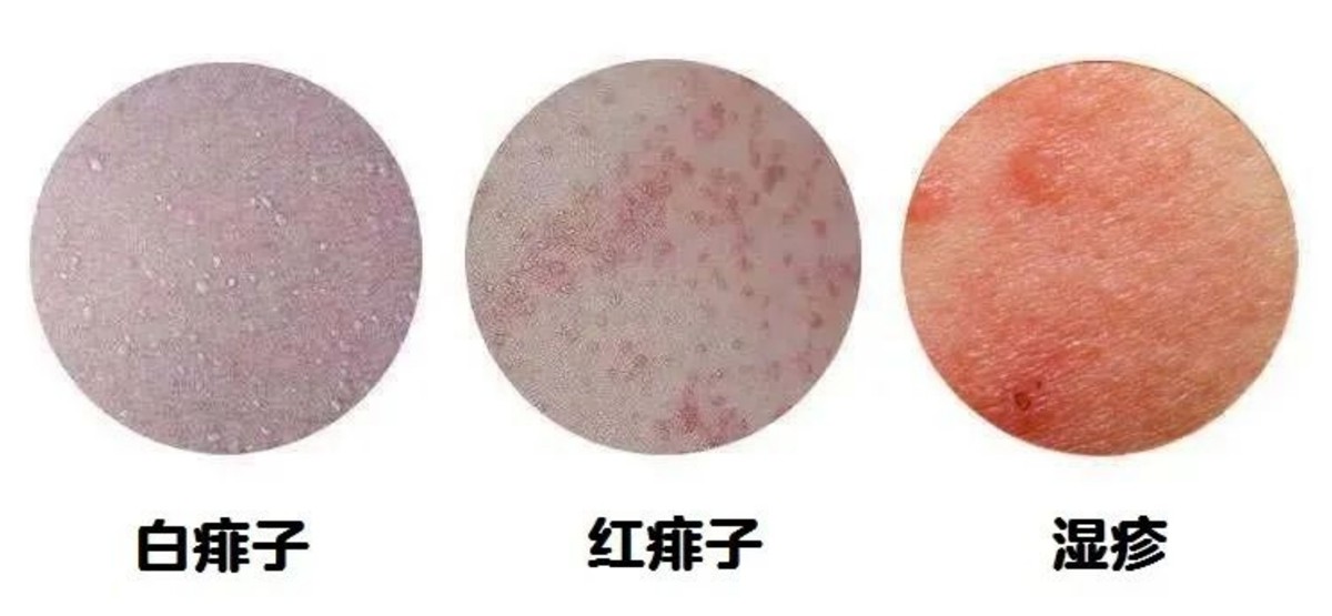 宝宝湿疹治疗过程四大禁忌,宝宝湿疹不要慌治疗湿疹有妙招